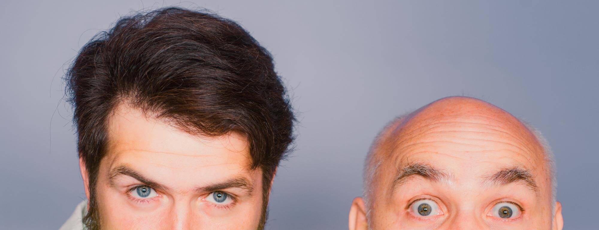 antonio conte hair transplant: before and after