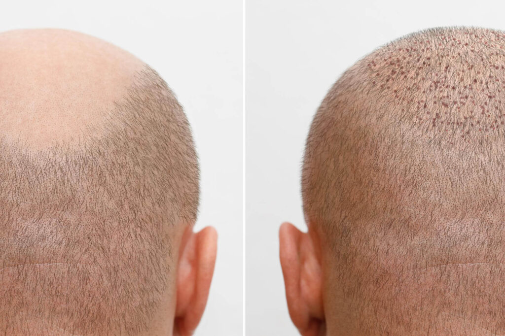 Jurgen Klopp hair transplant: before, after, technique